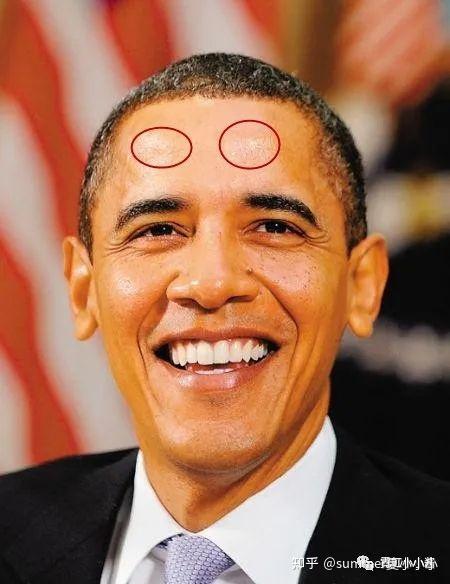 额结节△额结节,眉骨凸起,颞线清晰,大自然和医生都有鬼