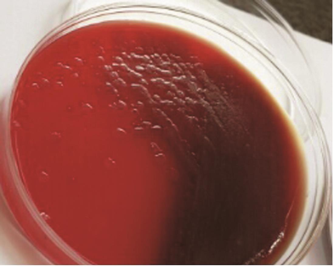 5.不可忽视的痰涂片