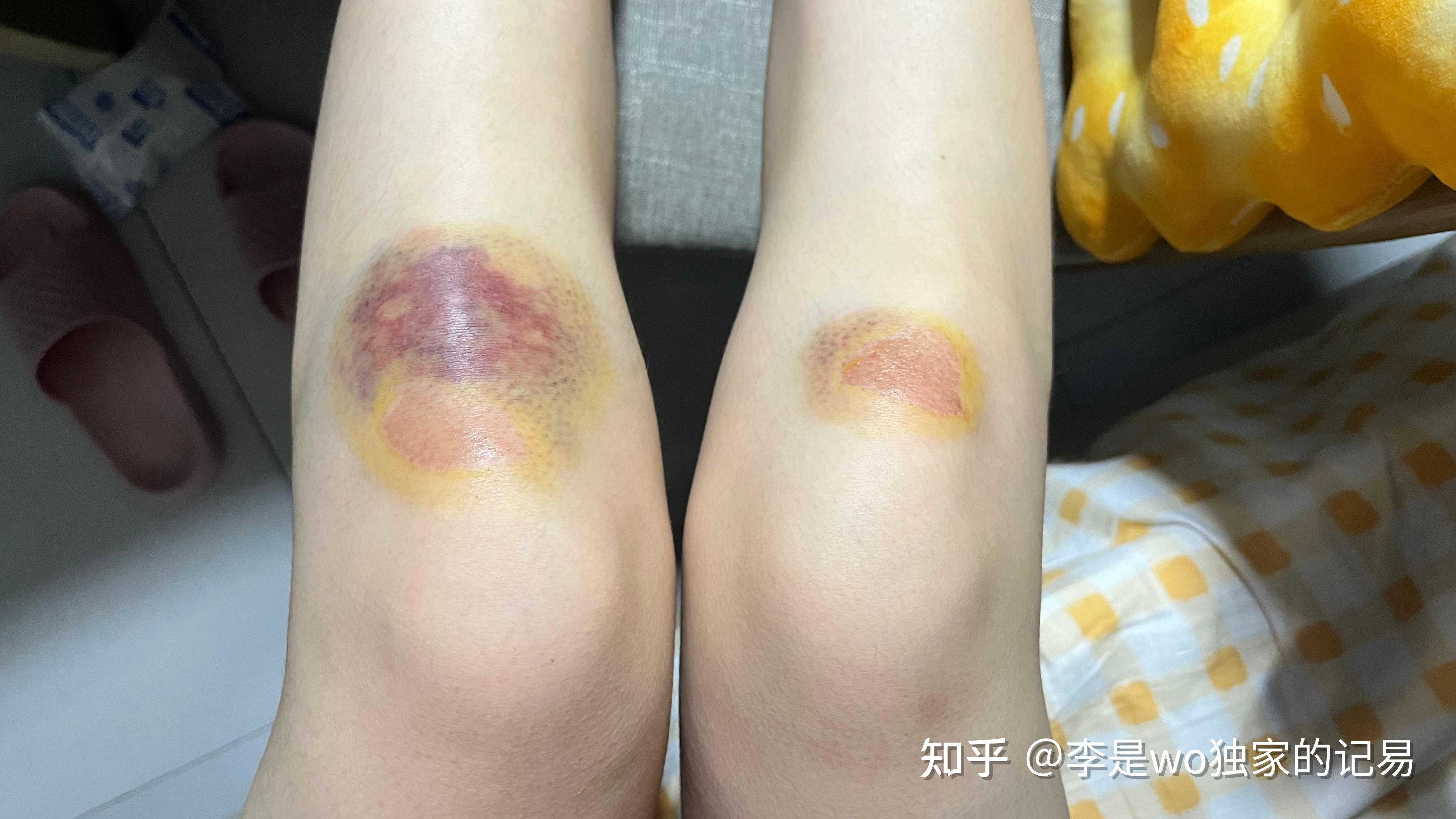 女孩脚受伤包扎的图片大全_脚受伤包扎视频_微信公众号文章