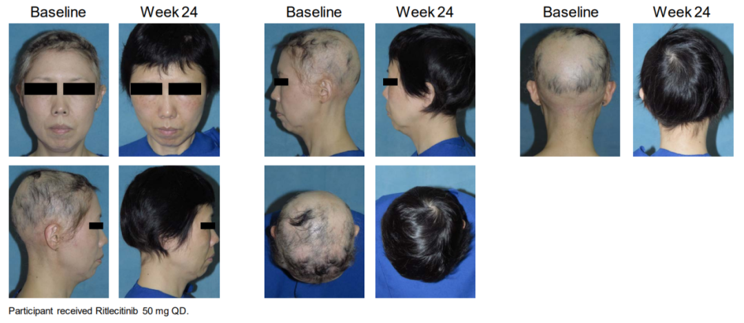 全球首个用于12岁及以上青少年和成人重度斑秃的新型生物制剂在华获批