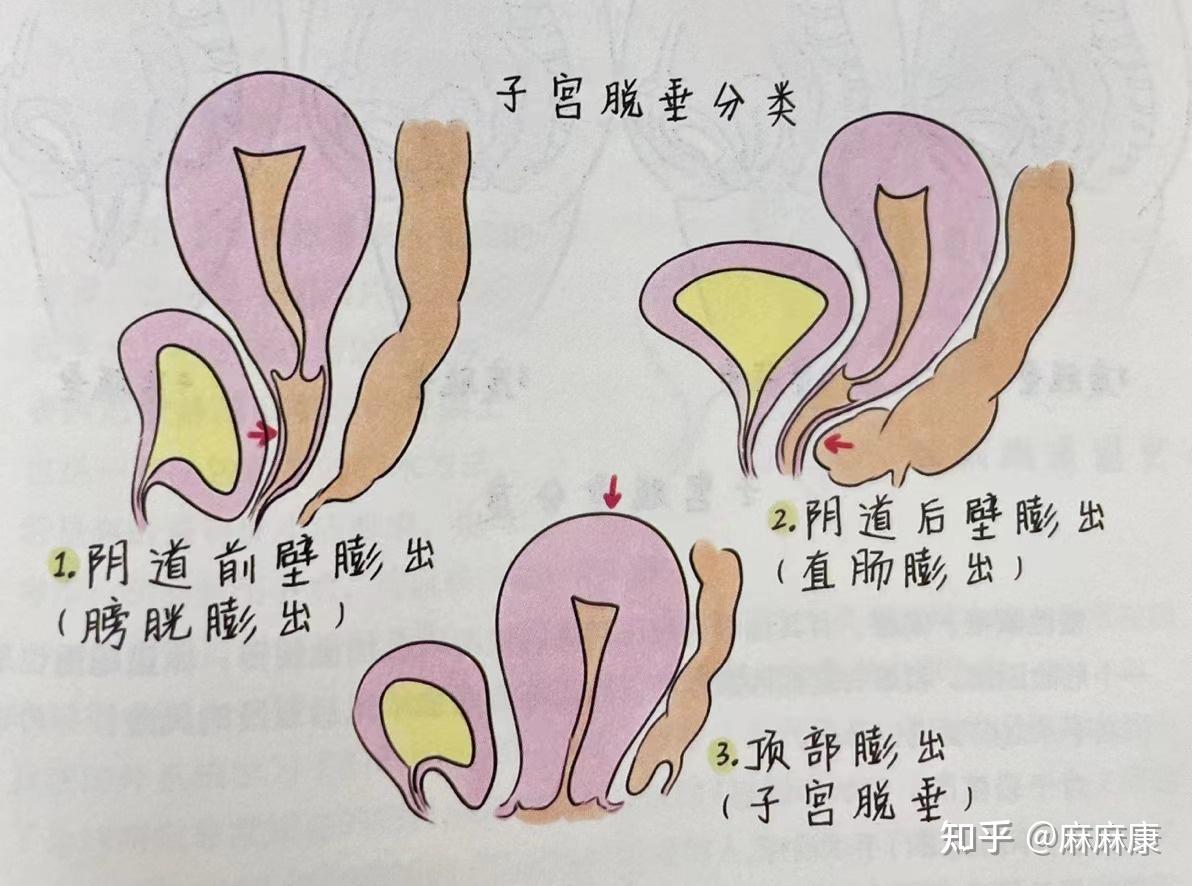 阴壁膨出怎么恢复正常图片