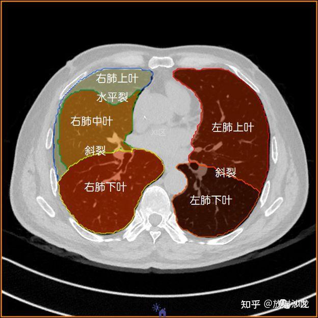 如此详细的肺部影像解剖有点儿酷