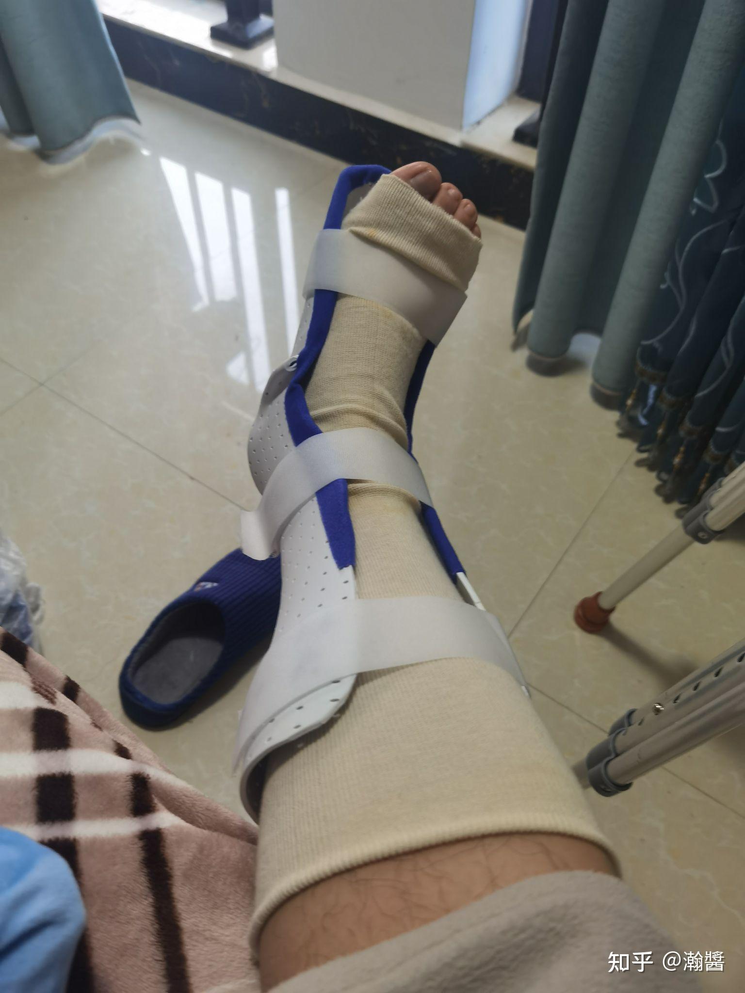 打篮球脚踝「撕脱性骨折+韧带断裂」 从受伤到康复日记 - 知乎