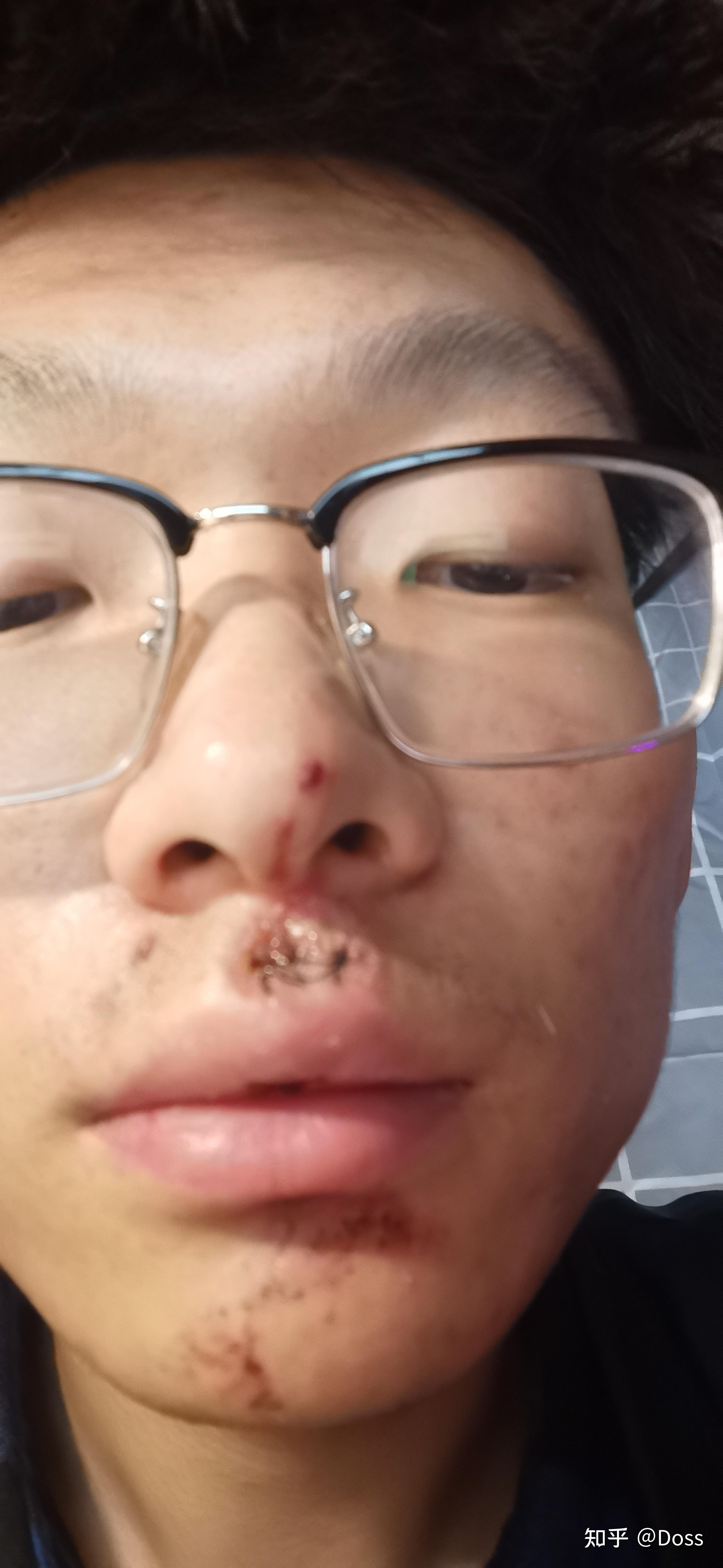 嘴唇创伤碎碎念