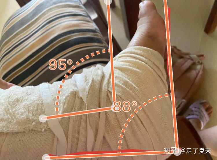 脚踝骨折三踝骨折的恢复过程记录