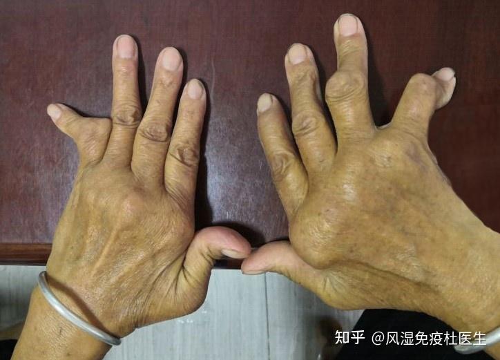 类风湿患者平均寿命有多长原来类风湿真的会影响寿命