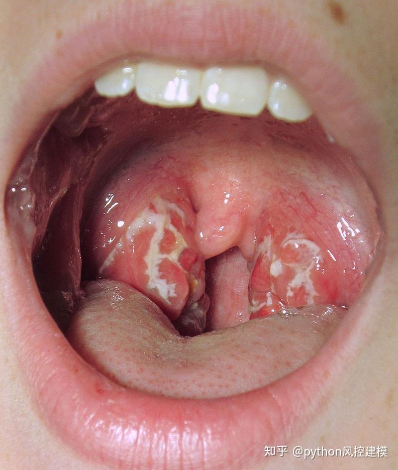 正常喉部图片