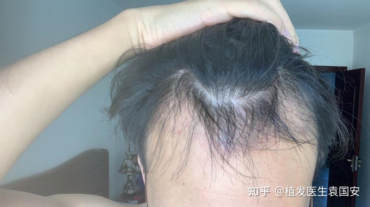 植发后植发区域生长很慢(植发后头发生长速度不一样)