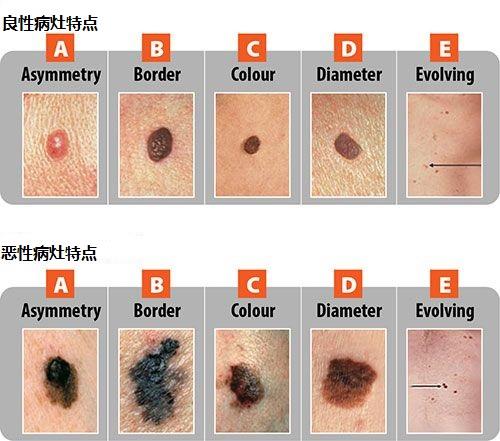 恶痣和善痣的区别图片图片