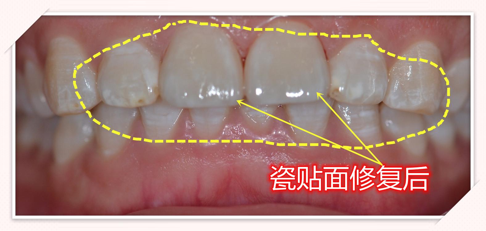 重慶牙齒修復:【門牙重度氟斑牙】 瓷貼面修復 - 知乎