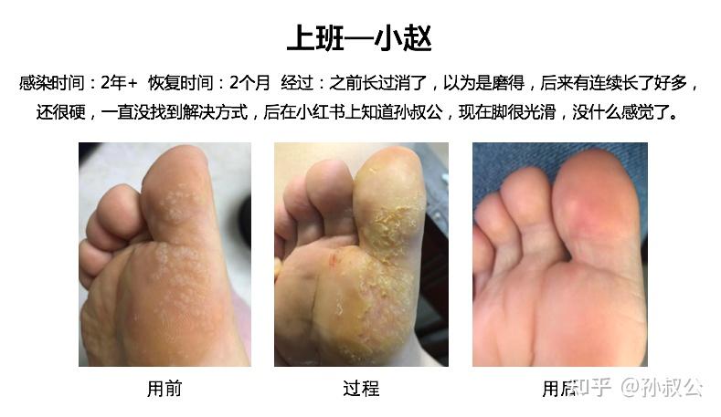 多颗跖疣20实例一招分清刺瘊鸡眼扁平疣详图版