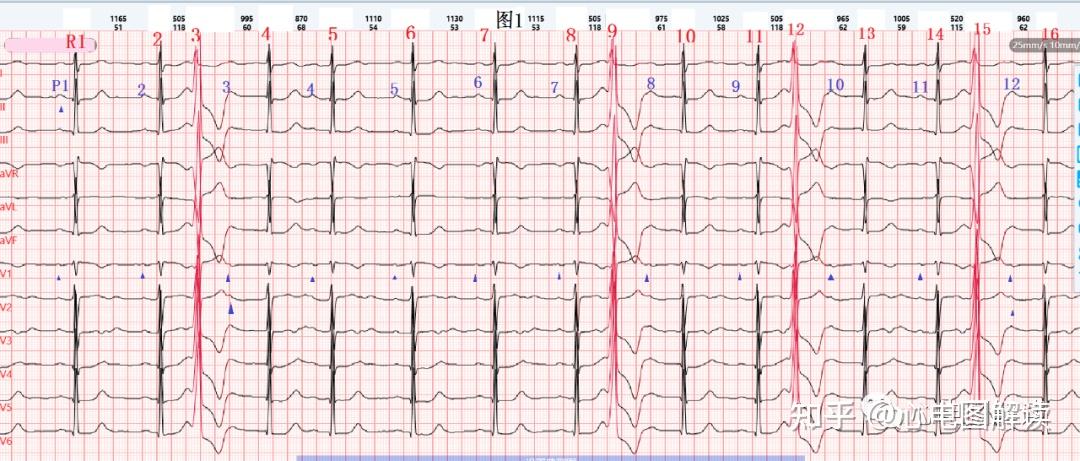 67圖1心電圖分析:看點:r4,10,13,16的性質.