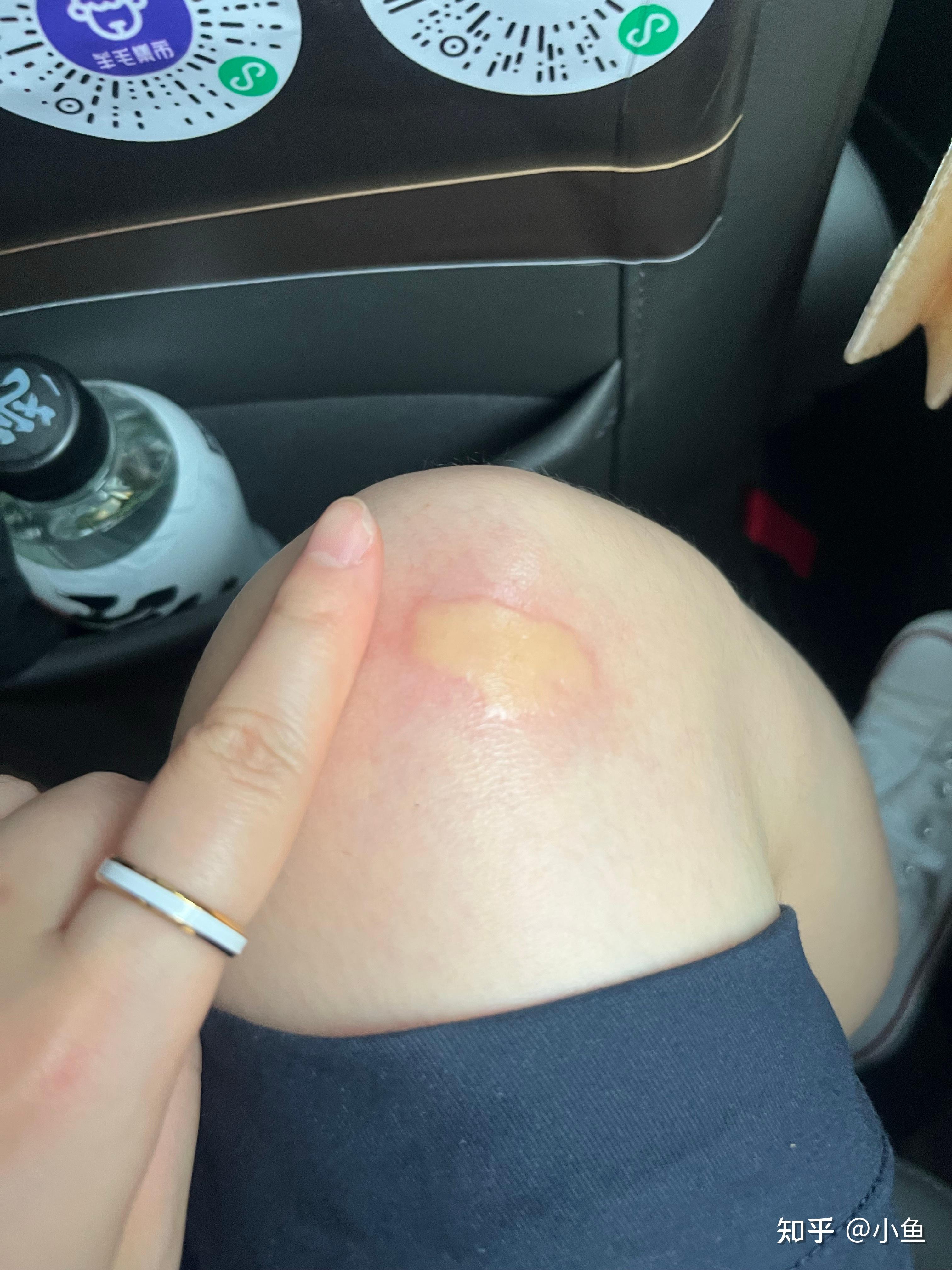 被蚊子咬的包第二天都肿的特别大怎办