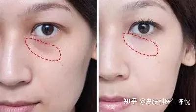 泪沟是由于什么造成的? - 知乎