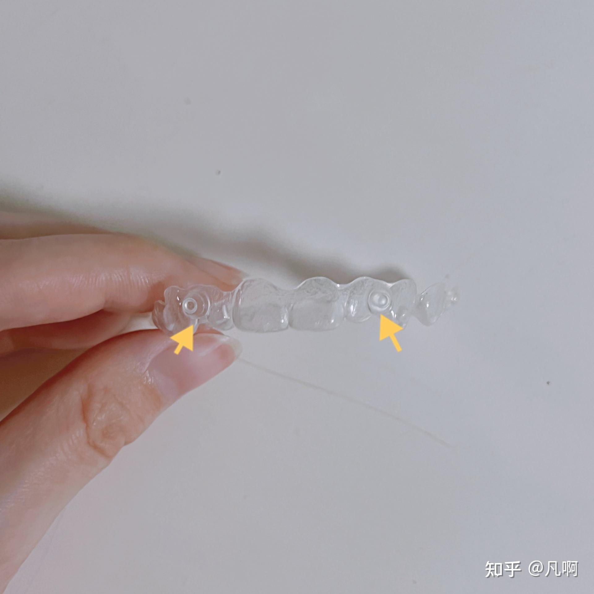 我牙上的透明部件增多,牙套外出现圆形小凸起,用来挂皮筋.