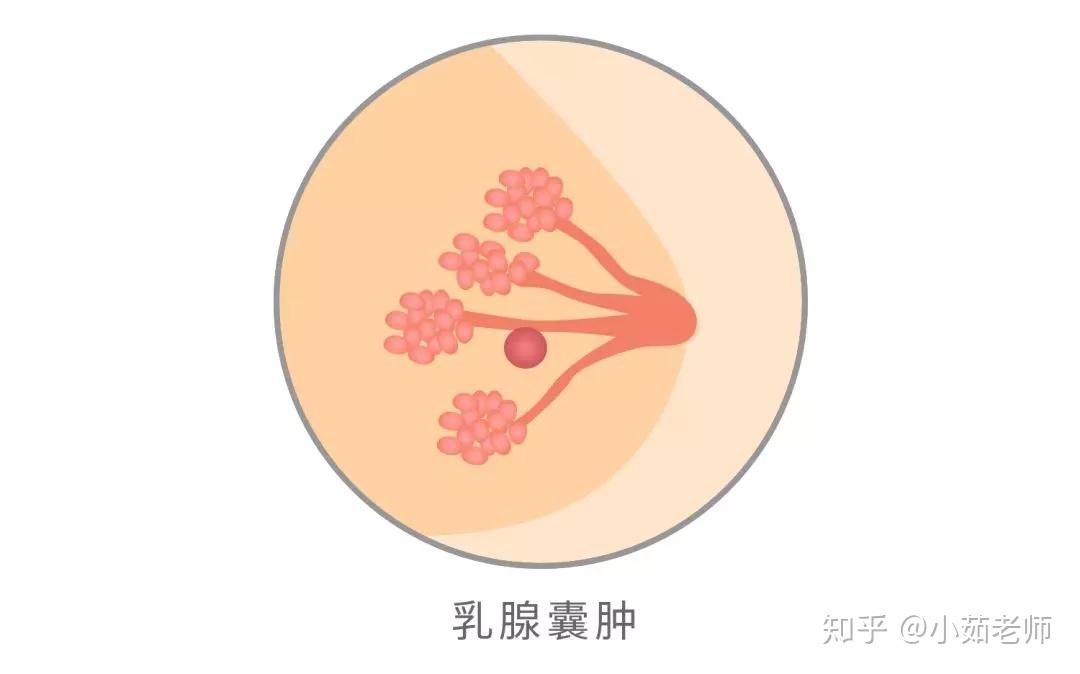 乳腺病,有多大可能癌变?