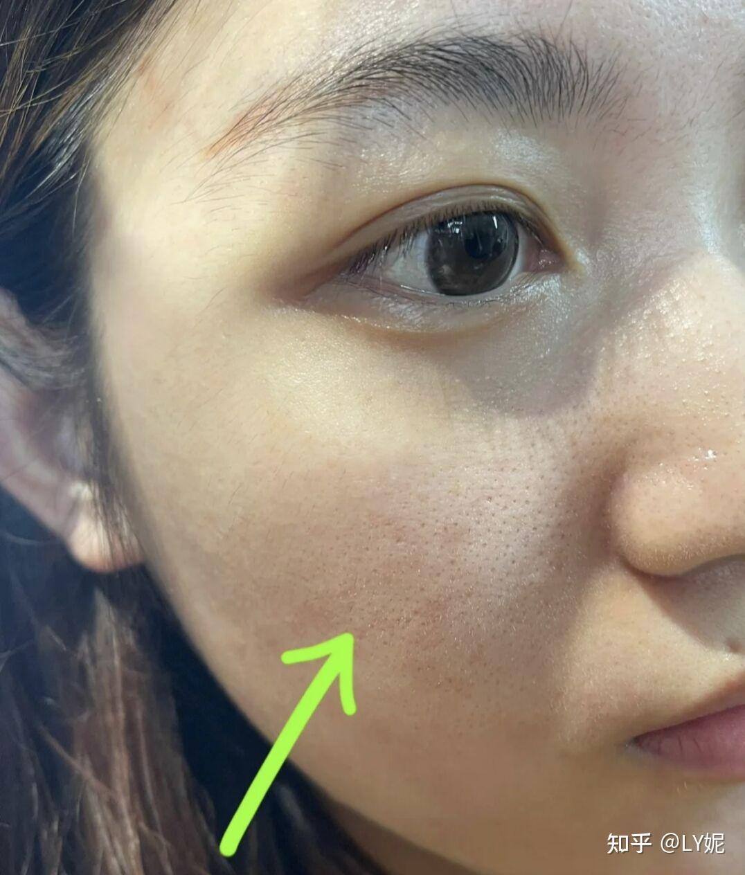 脸颊上的毛孔里面有硬硬黄色油脂粒,抠出来毛孔也变大了,刚开始只有两