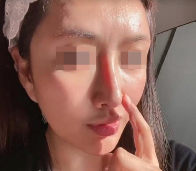 杭州隆鼻手术失败常见问题,杭州鼻修复案例分享 - 知乎