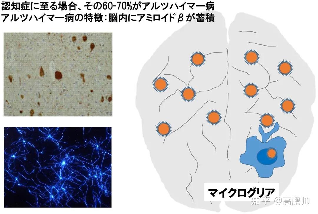 淀粉样蛋白β据说阿尔茨海默病是 60-70 所谓的痴呆症的原因