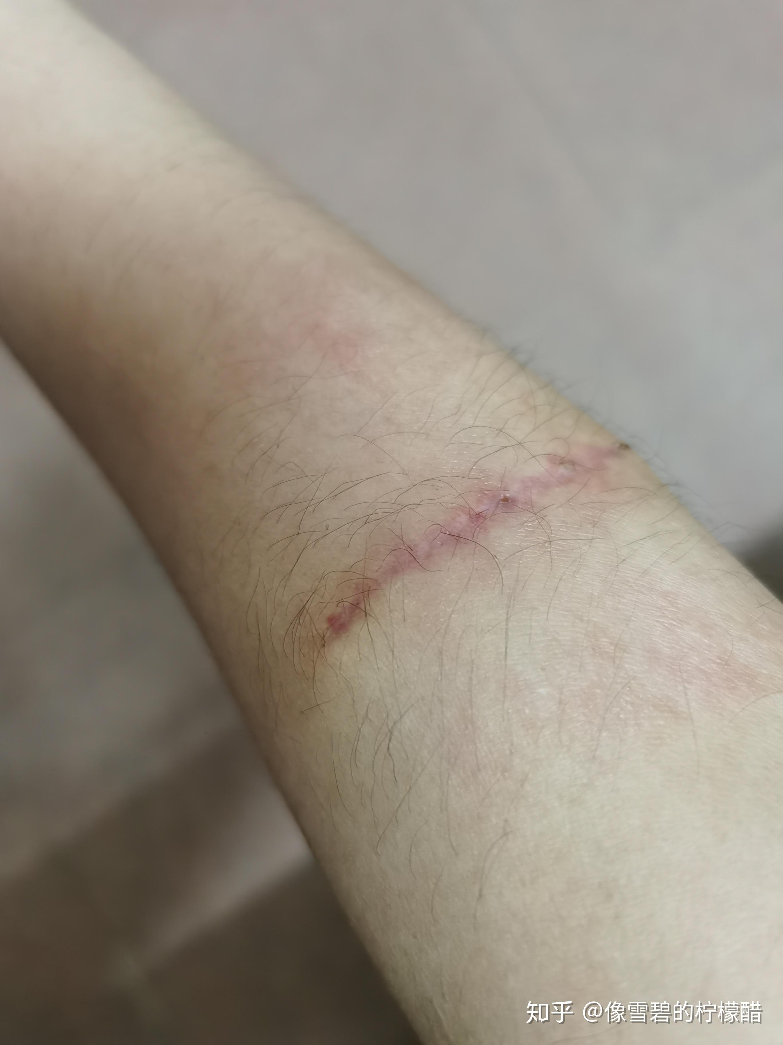 手部黑色素痣切除北京大学深圳医院