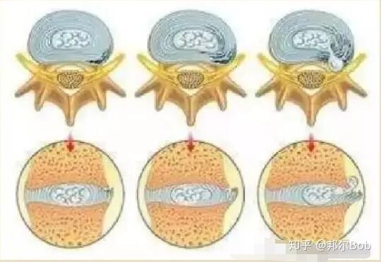 颈椎间盘突出怎么治根除 v2-606589003e9eec3c1a9ad83bffc3a996_r.jpg
