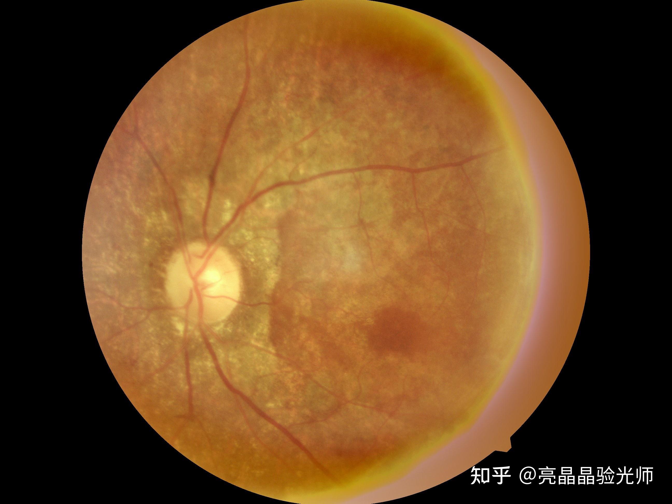 你了解你眼底的视网膜的健康吗？不妨每年给它做一次体检吧 - 知乎