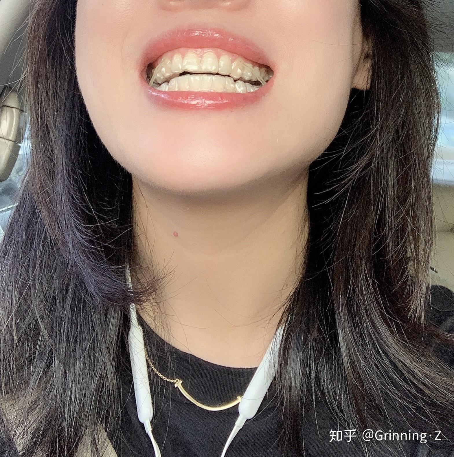 正畸分享#42岁我戴上了牙套