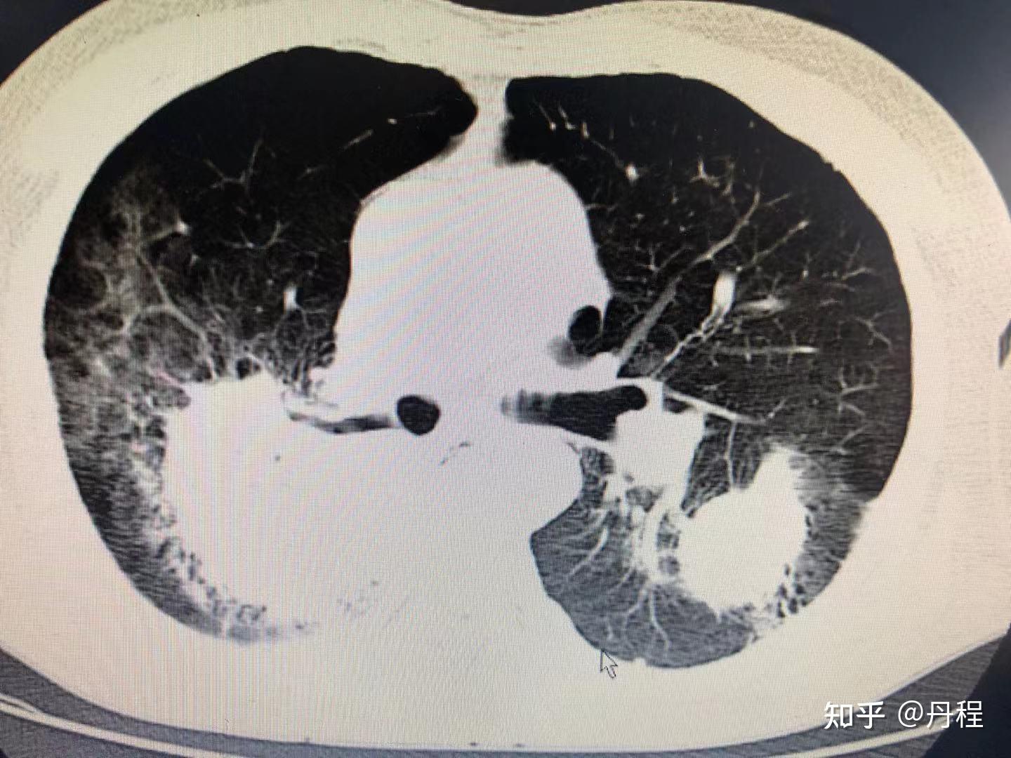 晚期不可切除非小細胞肺癌病例分享一例腺癌