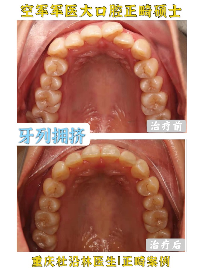 臨床檢查:安氏Ⅱ類,上下中線不齊,上下牙列輕度擁擠,有齲齒.