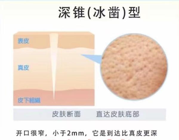 常见的痘坑类型