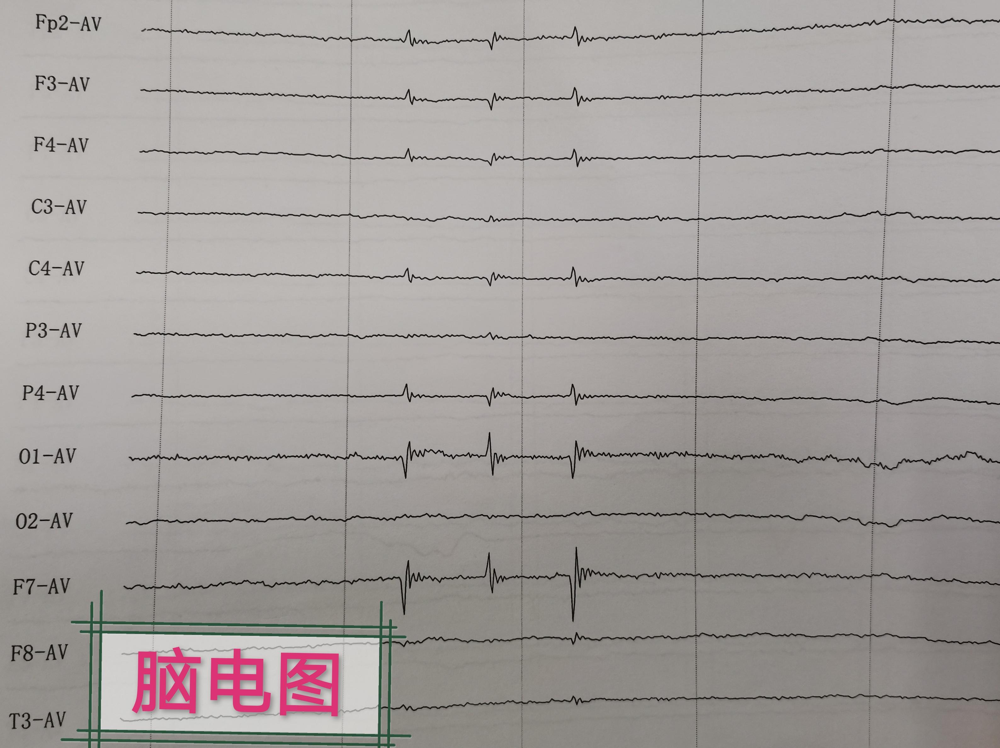 图3:4个月宝宝的的脑电图,本该非常活跃,却显示近乎一条直线.