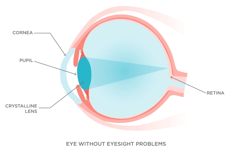 专家解析：遗传对近视的影响真有那么大？ 知乎