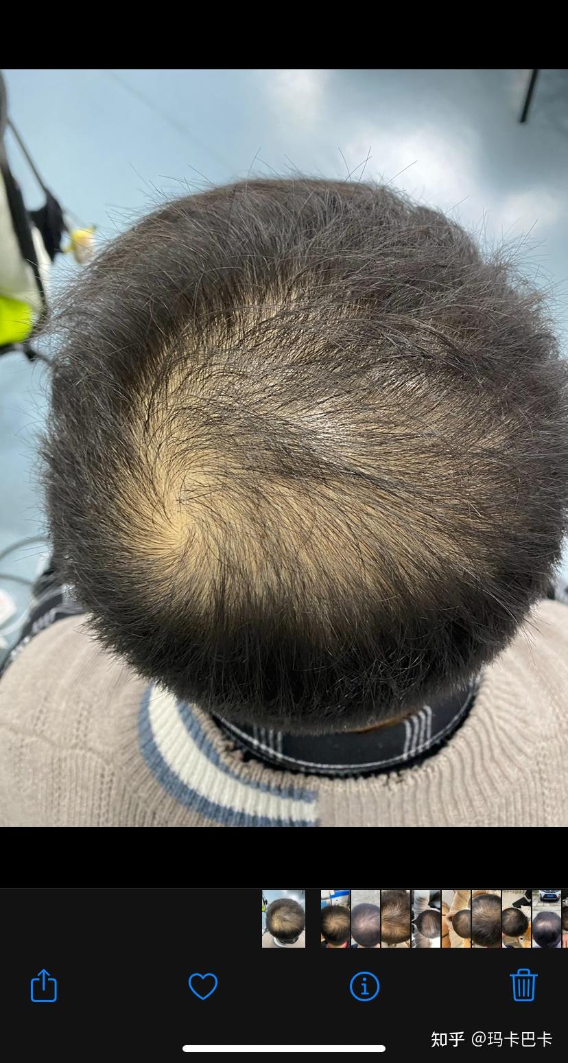 00后脱发记 - 知乎