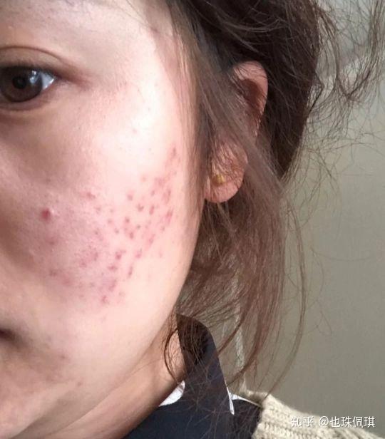你们用过的最有效的祛痘祛痘印的产品是什么? - 知乎