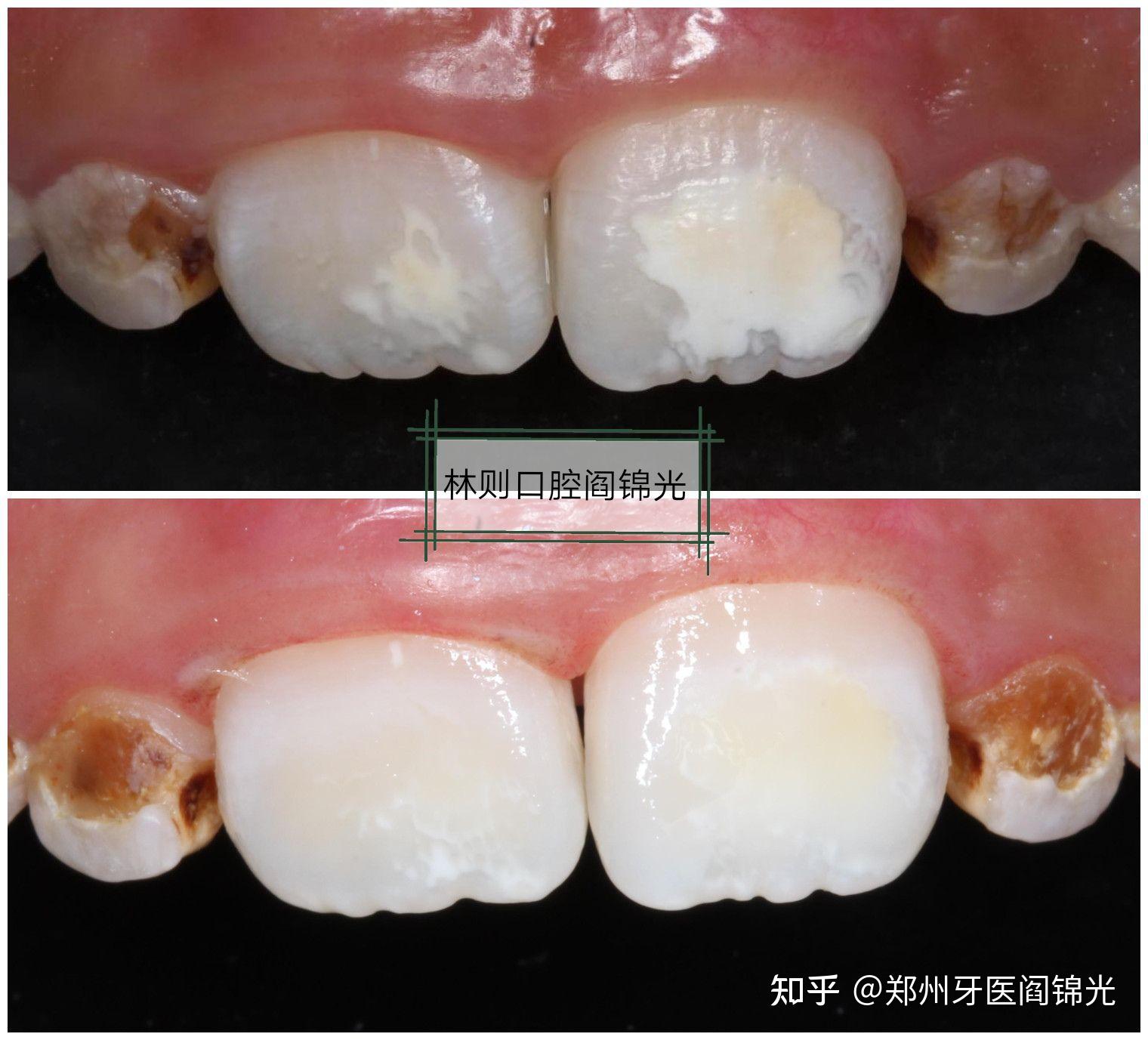 门牙上有白斑图片图片