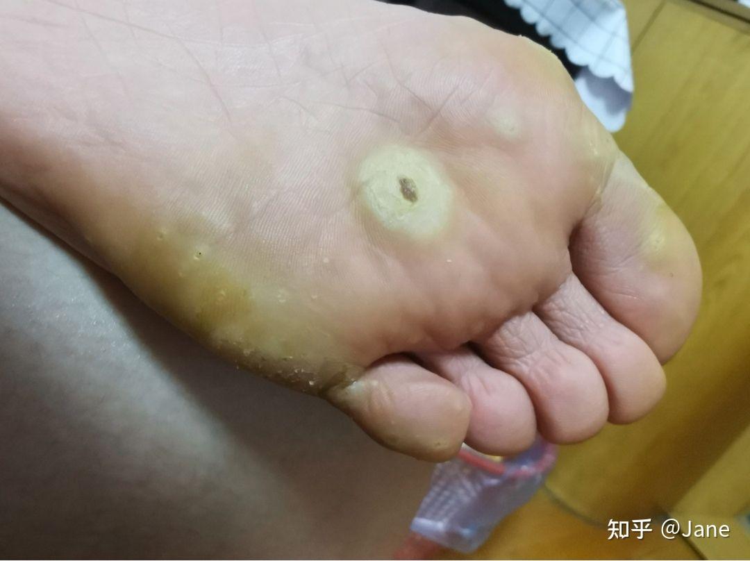4月24号,脚上跖疣覆盖处全部发白,角质特别厚4月19号,中药泡了一个