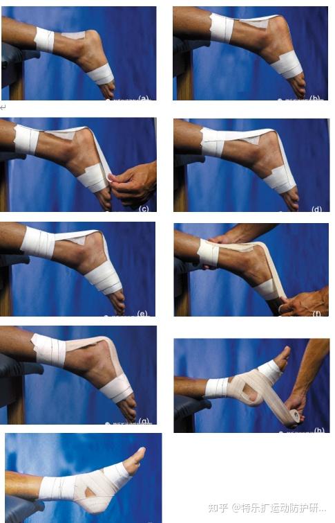 用于限制过度背屈以保护被拉长或发炎跟腱之贴扎流程,确定所需的背屈