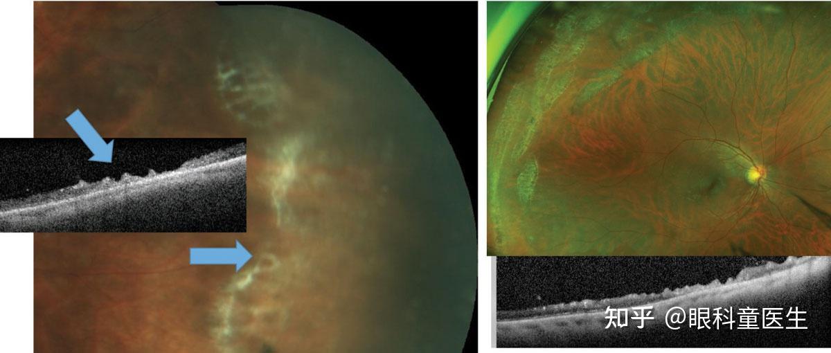 视网膜脱离的oct图片图片