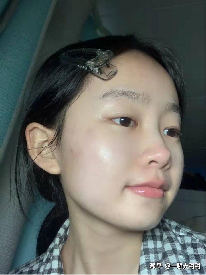 皮肤从满脸痘痘到白里透红是什么体验