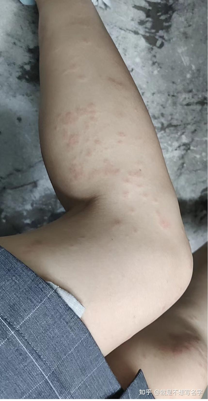 玫瑰糠疹14天康复记录