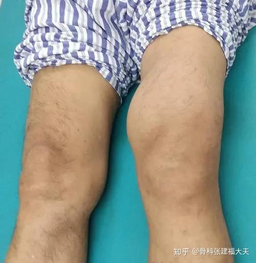 膝盖反复疼痛肿胀小心膝关节滑膜炎 知乎