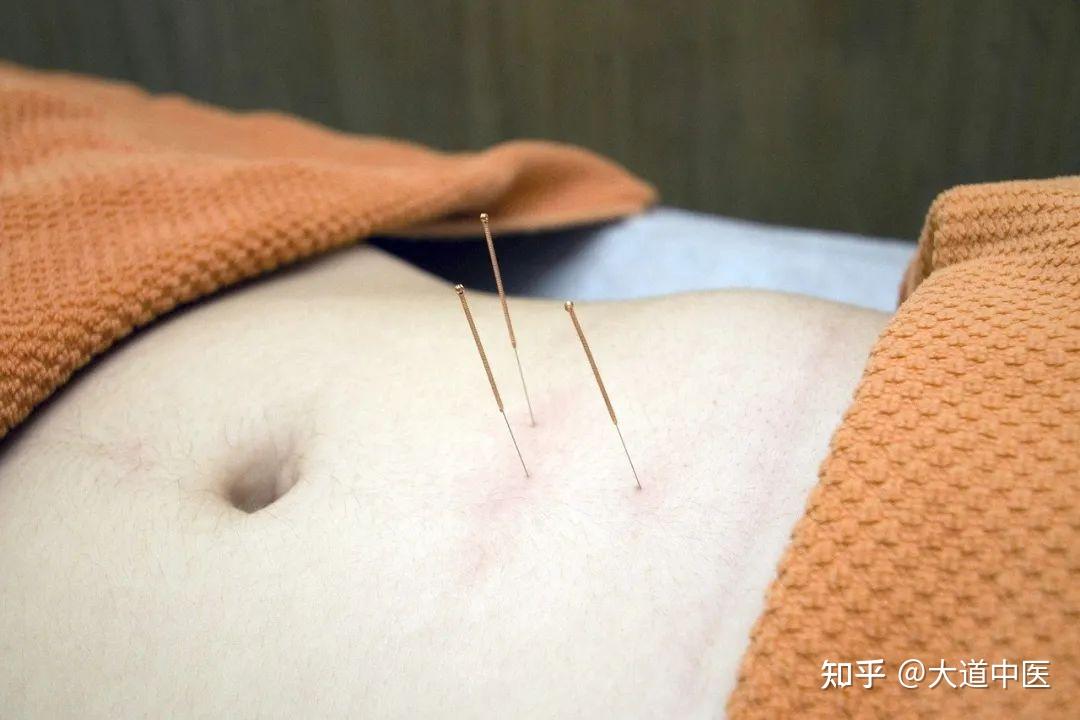 针灸的4个诀窍，记住了就容易学了 - 知乎
