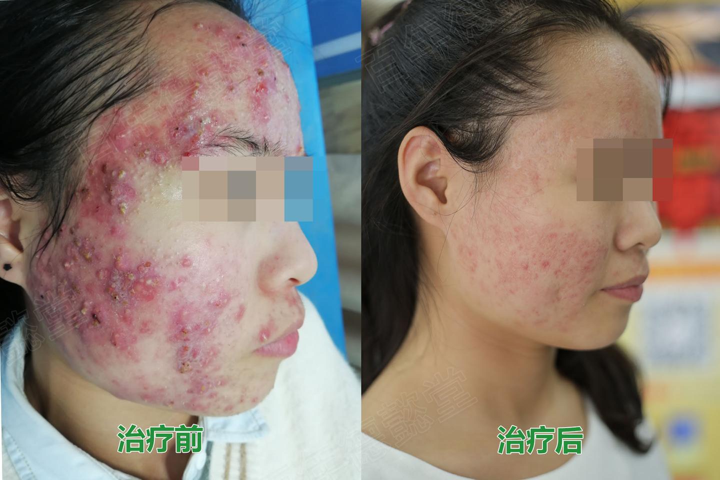 严重性痤疮青春痘治疗案例