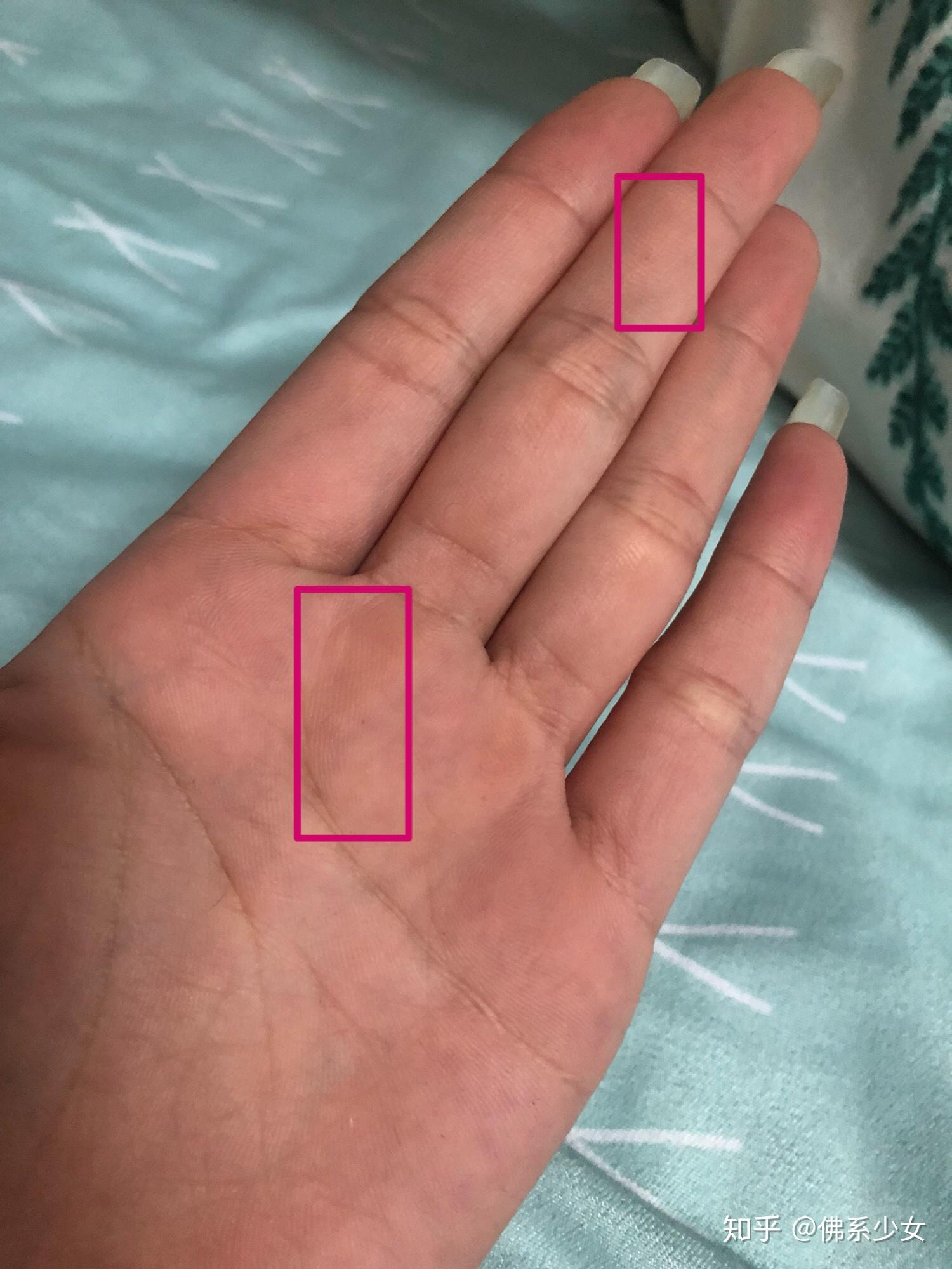 手掌上长了两个小红点跟小针孔一样 是怎么回事呢? 