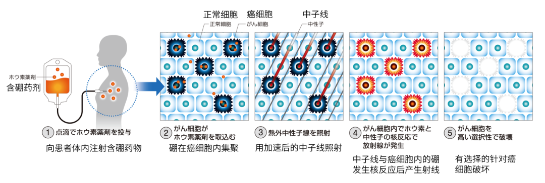 什么是硼中子捕获治疗 知乎