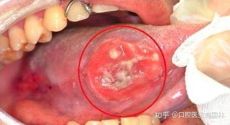 舌癌和溃疡的区别图片