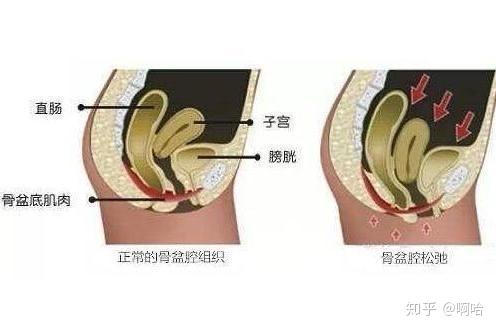 产后漏尿腰酸下腹坠胀盆底肌受损了关于盆底肌的小科普
