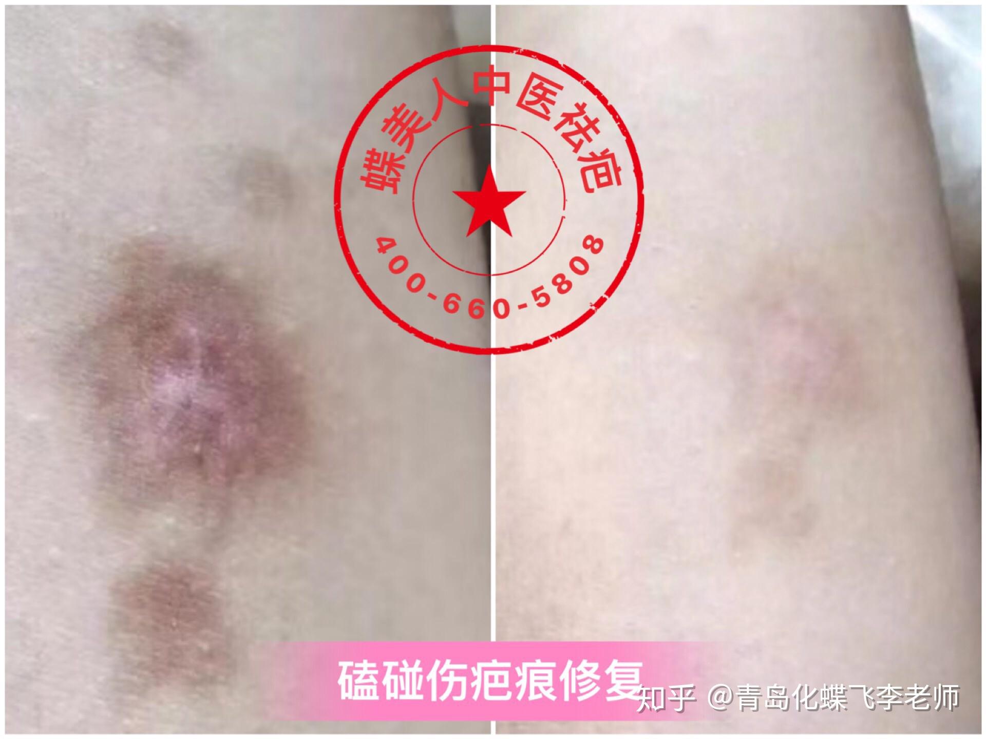 色素沉着或色素疤痕修复治疗