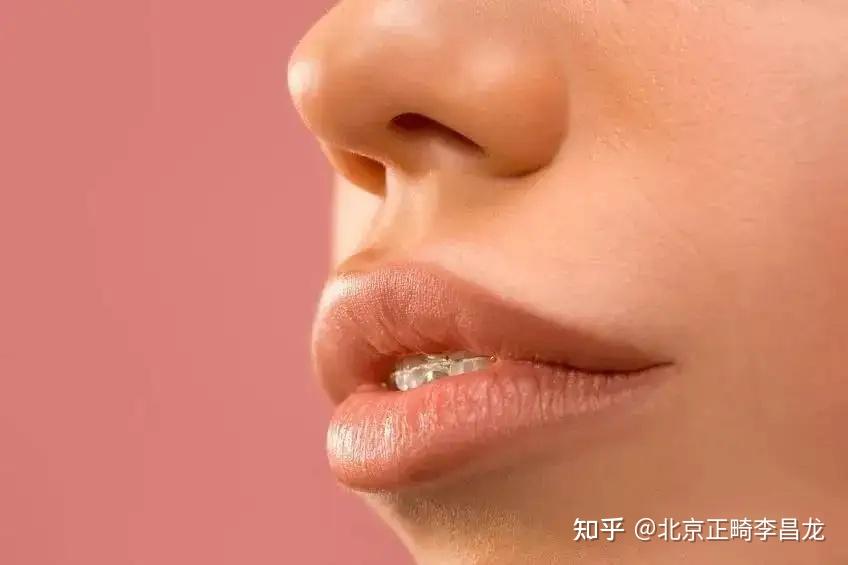 北京牙齿矫正正畸丨嘴凸矫正时内收多少比较合适