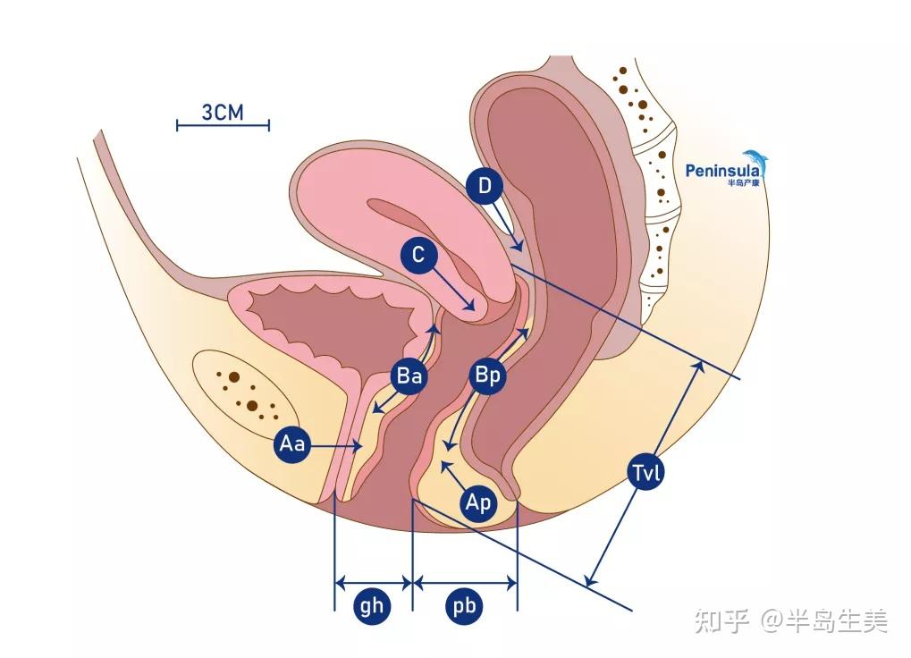 如何快速掌握pop-q评分?看这个就够了!